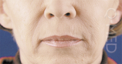 NASOORAL.jpg